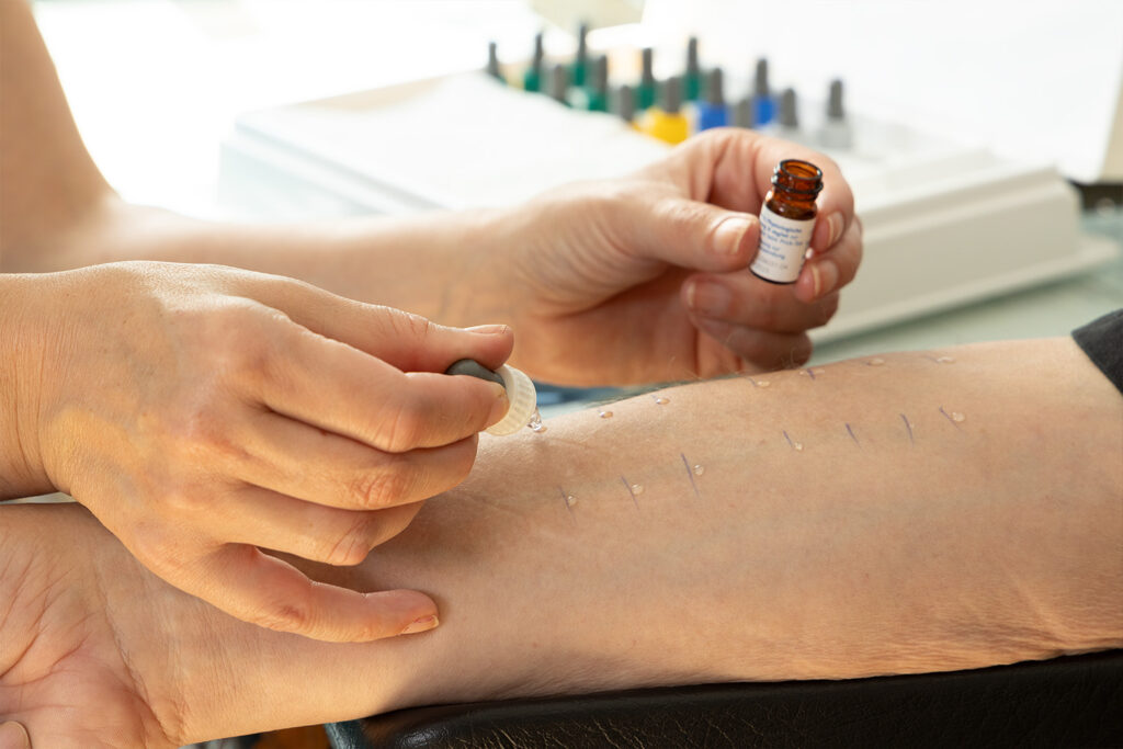 Allergietest am Arm